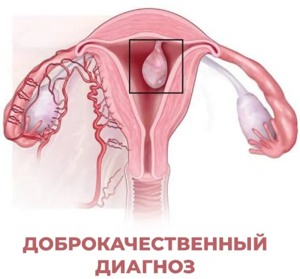 Полипы в матке: почему их нужно удалять до беременности
